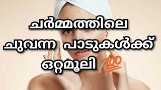 ചർമ്മത്തിലെ ചുവന്ന പാടുകള്‍ക്ക് ഒറ്റമൂലി‌‌ 💯|M4 Tips||malayali youtuber||Ep:259