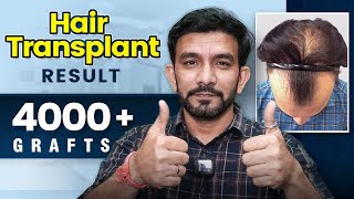 Remarkable Grade 6 Hair Transplant Results in India | 19-Month Transformation Result in India