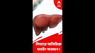 লিভারে অতিরিক্ত ফ্যাট? সাবধান !