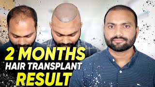 Hair Transplant in Gurgaon | Best Results \u0026 Cost of Hair Transplant in Gurgaon