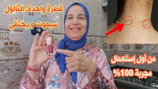 بصباغة الأظافر تخلص من الثالول وفي يوم واحد فقط قطرة واحدة سيموت ويختفي وصفة مجربة تغنيك عن طبيب