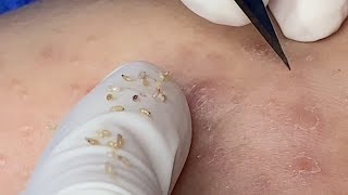 Blackheads Under The Skin | Mụn Đầu Đen, Mụn Ẩn - SacDepSpa#284