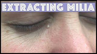 Extracting a Milia under the eye