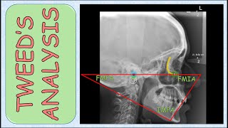 Tweeds Analysis | Cephalometric Analysis