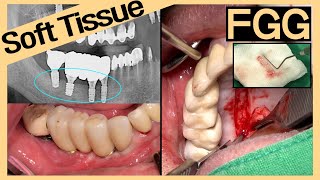 [Online Surgery] Soft tissue management to improve oral hygiene (FGG technique)