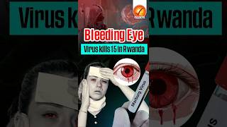 Bleeding Eye Virus kills 15 in Rwanda