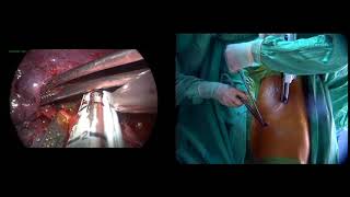 Asvide: VATS lobectomy using a biportal caudal approach