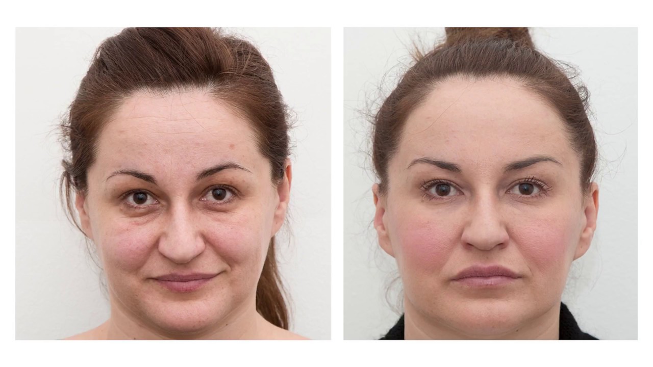 The Results Of Dermal Fillers: Before And After - YouTube