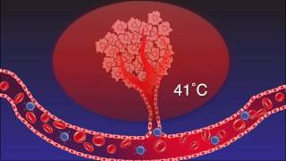 How Hyperthermia jumpstarts the Immune Modulation Effect to Fight Cancer