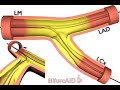 Cullot technique ,DK crush, LMS stenting Animation