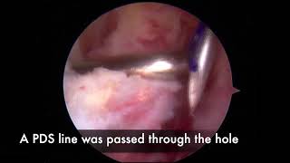 Modified Arthroscopic Bristow Procedure