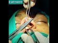 nasal tip creation suture ( Dome creation)- Dr Jalil Mujawar