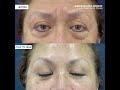 BLEFAROPLASTIA INFERIOR + SUSPENSION DE CEJAS - POST 15 DIAS