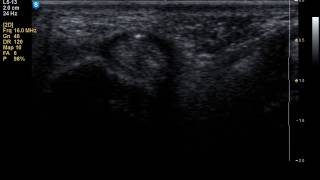 Ultrasound guided out-of-plane injection of the trigger finger,short axis view of the flexor tendons