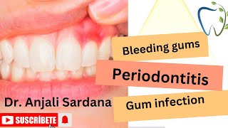 Bleeding gums/ Gums infection/ Periodontitis.        #youtubeshorts #shorts #oralhealth