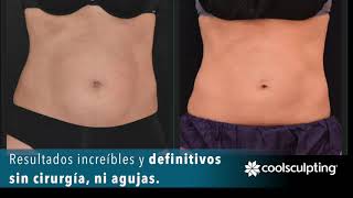 CoolSculpting, el tratamiento que acabará definitivamente con la grasa localizada.