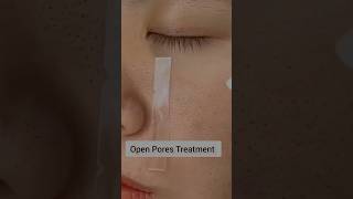 Open Pores Treatment #shorts #openporesremedy