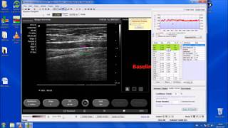 Analysing Flow-mediated Dilatation Data using Medical Imaging Applications Software (Part 2)