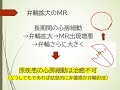 僧帽弁閉鎖不全症の誤った認識 「mrによる心不全」が間違いな理由を循環器医が説明します