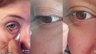 Super Satisfying EyE String And Eye Booger Removal | TiKTok Compilation