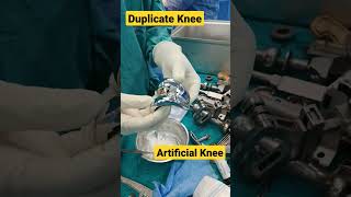 Total Knee Replacement ✓ | #totalkneereplacementsurgery #kneereplacementoperation #kneearthritis