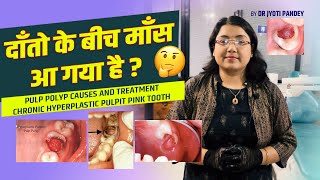 दाँतो के बीच माँस आ गया है ? Pulp Polyp causes and Treatment,Chronic hyperplastic pulpits pink tooth