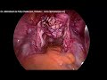 laparoscopic adenomyomectomy flap technique repair