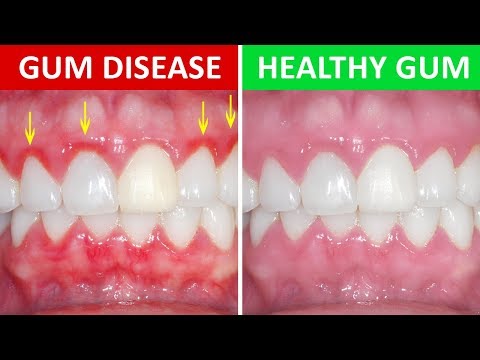 How to Get Rid of Gingivitis at Home (Gum Disease) How to Get Rid of Gingivitis at Home (Gum Disease)