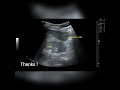 case 132 chilaiditi syndrome riedel lobe .