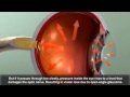 glaucoma animation