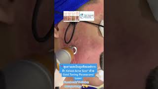 ดูแล*แผลเป็นนูนคีลอยด์จากสิว Keloid Acne Scar* ด้วย Gold Toning Picosecond Laser หมอรุจชวนคุย