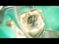 root canal retreatment missed mb2 canal