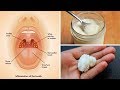 3 Powerful Home Remedies for Tonsillitis That Work Fast! 3 Powerful Home Remedies for Tonsillitis That Work Fast!