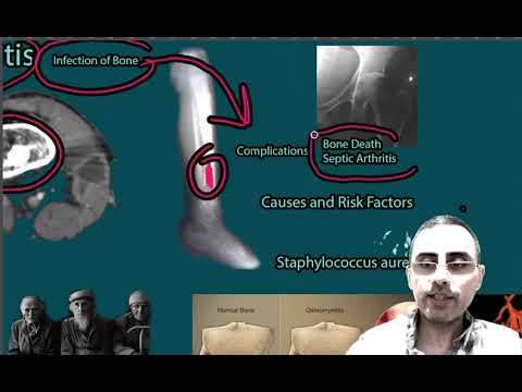 What are the risk factors of osteomyelitis?