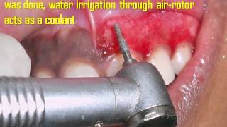 Gingival Depigmentation Procedure Using Diamond Bur... Case By Dr. Akash Akinwar