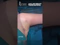 removal of axillary breast tissue shorts