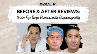 Before and After: Under Eye Bags Removal with Blepharoplasty | Wave Plastic Surgery