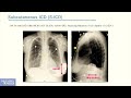 overview of pacemakers icds crt and ablation for nurses techs and device clinic staff