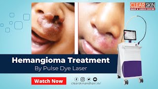 Hemangioma Treatment by PDL Pulse Dye Laser || Pulsed Dye Laser Treats a Variety of Red Skin Marks