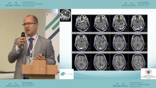 New paradigm in the treatment of brain and spine metastasis