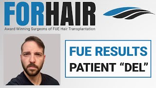 From Norwood 6 to Full Head of Hair! - Patient DEL Hair Transplant by Dr. Cole