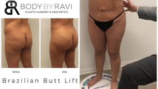 Fat Transfer to Buttocks After Liposuction