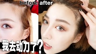 【我去动刀了？ 科普纹发际线VLOG】