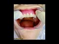 how to pit dental full denture upper and lower