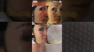 M22 超光子嫩肤美白祛斑，强力结合OptiLight模式，治疗黑眼圈干眼症👁👁👁👁