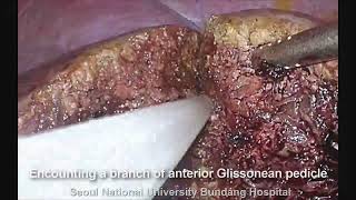 Laparoscopic Segment 4 Resection Including Middle Hepatic Vein with Vaginal Extraction of the Sp...