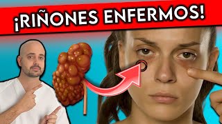 SIGNO Nº1 de RIÑONES ENFERMOS || ¡AVISAN de INSUFICIENCIA RENAL!