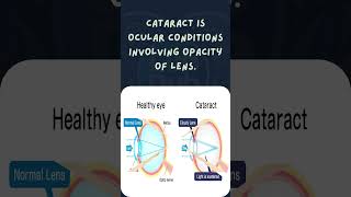 What is cataract ? 🤔👁️ #viralshorts #trendingshorts #trending #cataract #ophthalmology #medicos