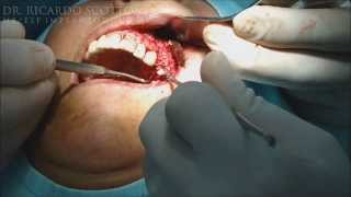 Enxerto Homólogo com tela de titanio (HD) - BONE REGENERATION WITH TITANIUM MESH