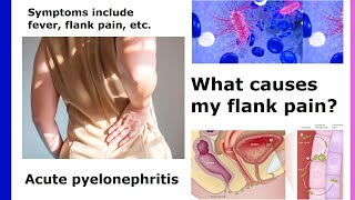 acute pyelonephritis
